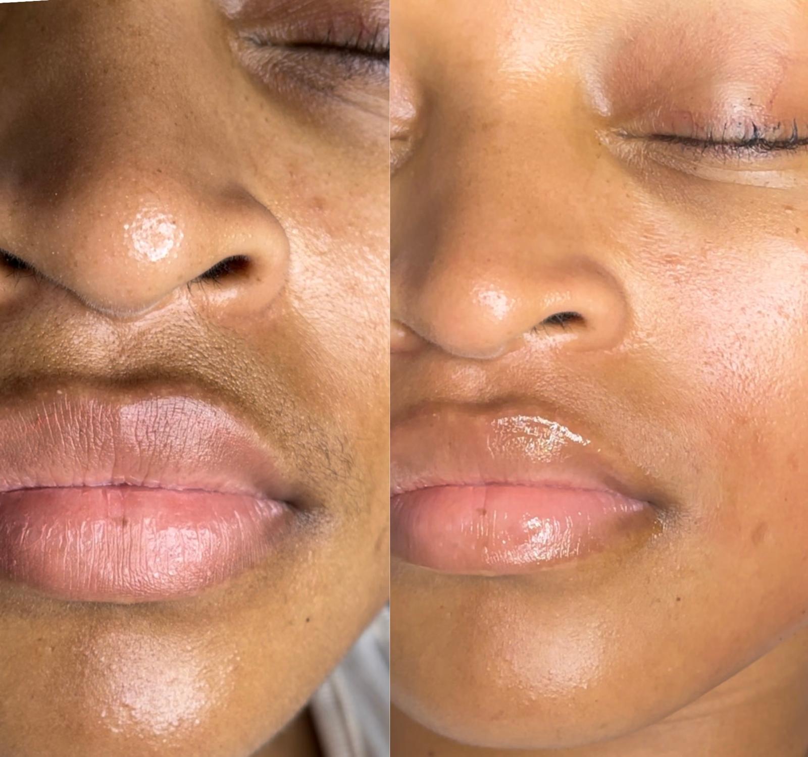 Derma-Planing